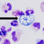 The brain-eating amoeba kills 97% of its victims. Scientists may have found a way to stop it within hours