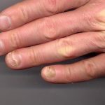 GLP-1 users report nails falling off: ScienceAlert
