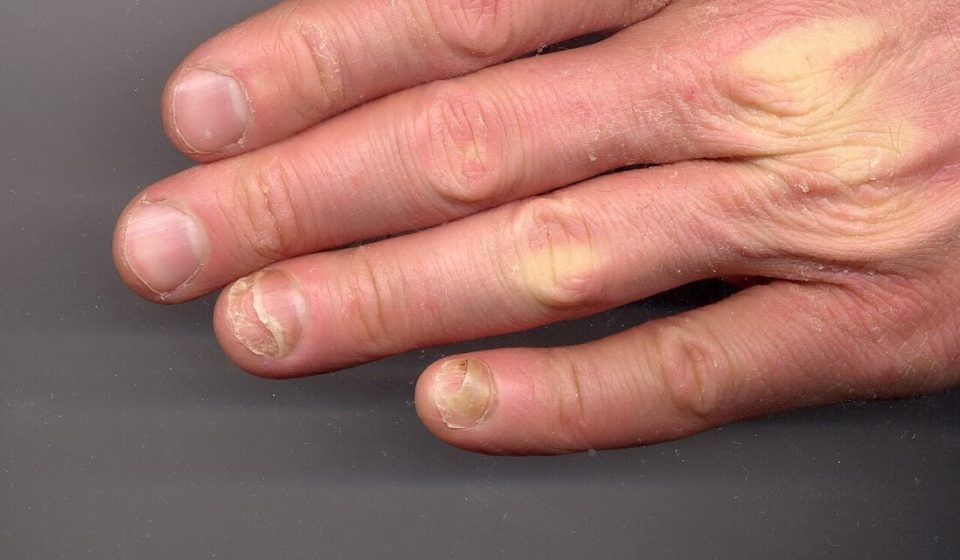 GLP-1 users report nails falling off: ScienceAlert