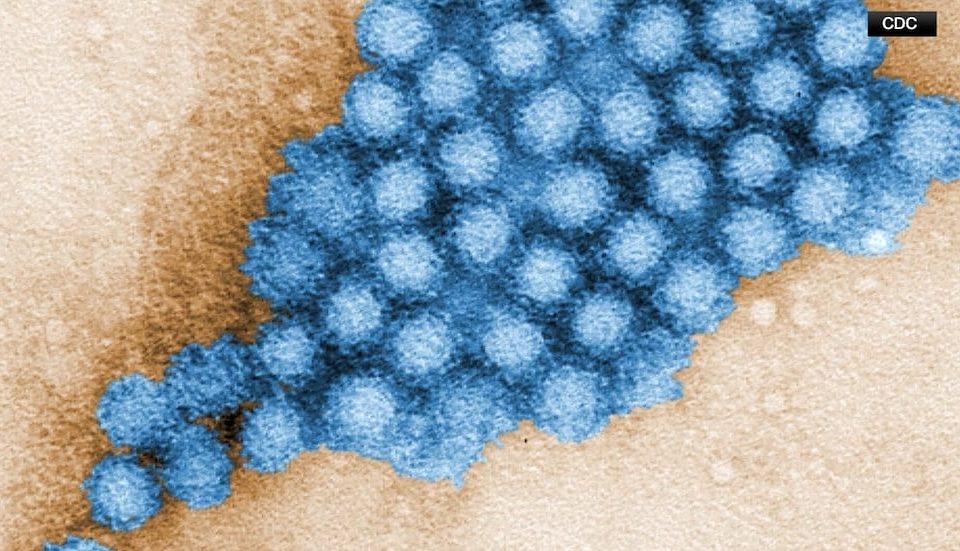 Norovirus outbreak confirmed at metro area elementary school with approximately 85 cases reported