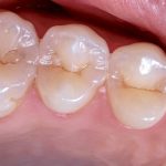 FDA approval for no-drill cavity care could be imminent after large Phase 3 treatment trial