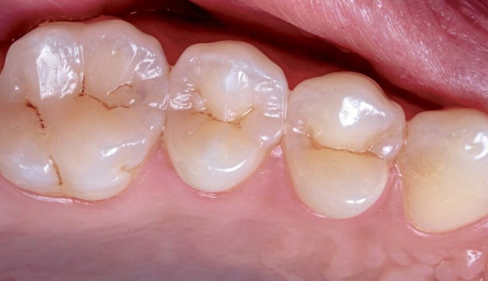 FDA approval for no-drill cavity care could be imminent after large Phase 3 treatment trial
