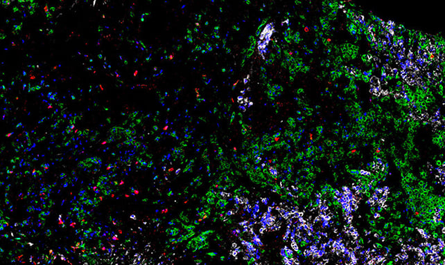 Neglected immune cell killed deadliest form of lung cancer in lab tests: ScienceAlert