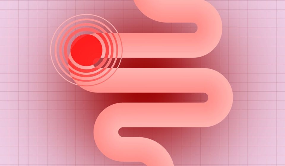 Scientists Just Connected 2 Types of Ultra-Processed Foods to Reduce Colon Cancer Risk
