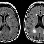Weaker bones linked to faster brain aging in new study: ScienceAlert