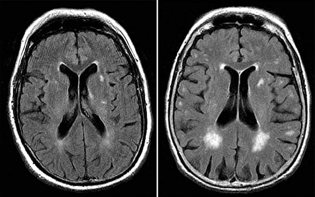 Weaker bones linked to faster brain aging in new study: ScienceAlert