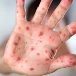 Measles case reported in Huntsville