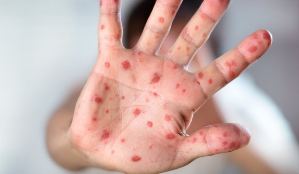 Measles case reported in Huntsville