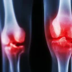 New Knee Arthritis Treatment Provides Long-lasting Pain Relief Without Surgery