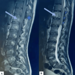 Spinal cord compression syndrome revealing thoracic Ewing sarcoma in a young adult: report of a case - Cureus