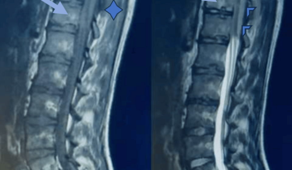 Spinal cord compression syndrome revealing thoracic Ewing sarcoma in a young adult: report of a case - Cureus