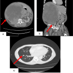 Giant papillary renal cell carcinoma: a rare case of 31 cm renal mass with suspected metastatic disease on imaging - Cureus