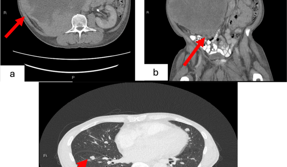 Giant papillary renal cell carcinoma: a rare case of 31 cm renal mass with suspected metastatic disease on imaging - Cureus