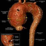 A giant atherosclerotic ascending aortic aneurysm (13.5 cm) with arch involvement successfully managed with total arch replacement with valve preservation: a case report - Cureus
