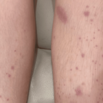Skin as the First Clue: A Case Report of Immunoglobin A (IgA) Vasculitis - Cureus