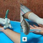 Saline injection could offer longer relief from carpal tunnel pain: ScienceAlert