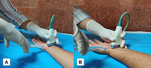 Saline injection could offer longer relief from carpal tunnel pain: ScienceAlert