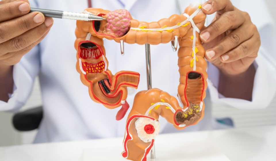 4 “different” and more dangerous symptoms of colorectal cancer in adolescents