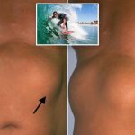 Strange benign chest masses discovered in SoCal surfers