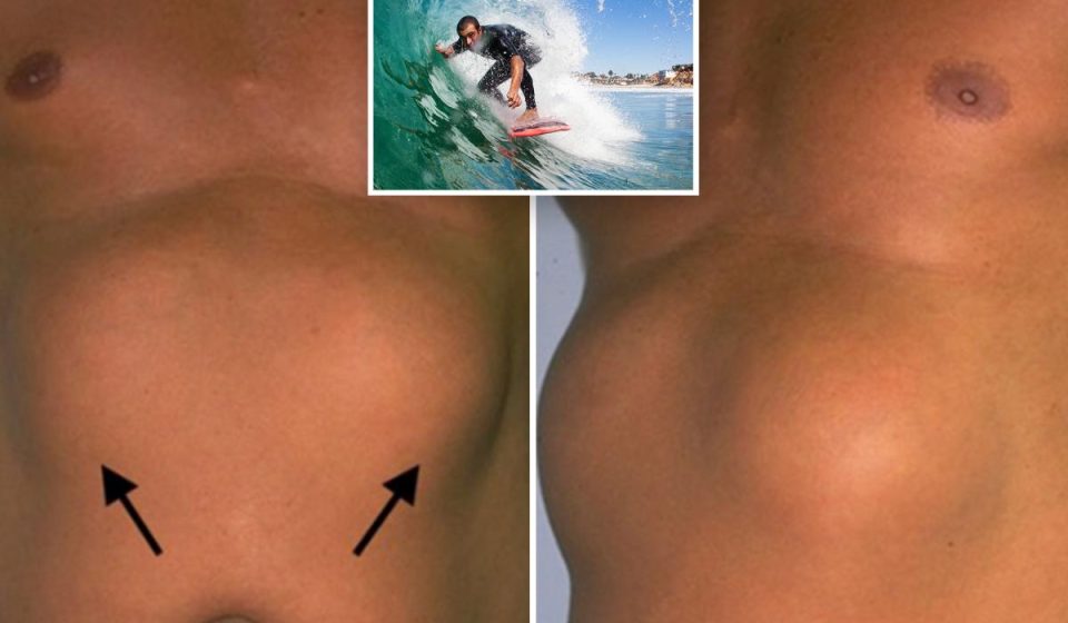 Strange benign chest masses discovered in SoCal surfers Strange benign chest masses discovered in SoCal surfers