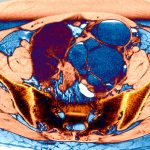 The “missed disease” that affects 190 million people: an endometriosis drug seems promising