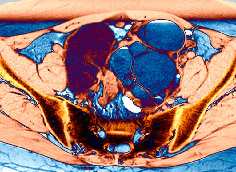 The “missed disease” that affects 190 million people: an endometriosis drug seems promising The “missed disease” that affects 190 million people: an endometriosis drug seems promising