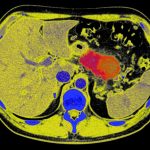 Can pancreatic cancer be stopped in its tracks? Radical tactic raises hopes
