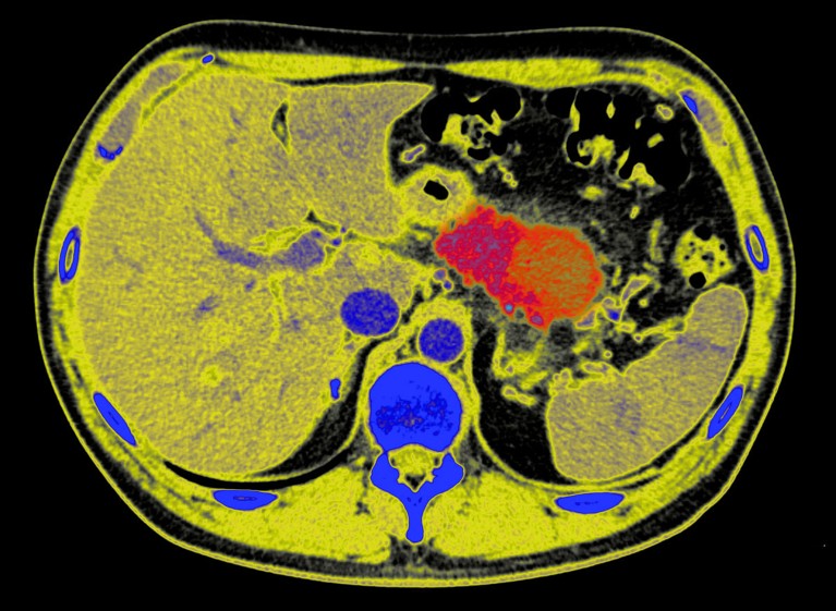 Can pancreatic cancer be stopped in its tracks? Radical tactic raises hopes