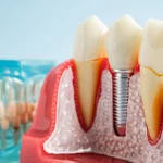 Dental Implants May Hijack Your Immune System, Scientists Find