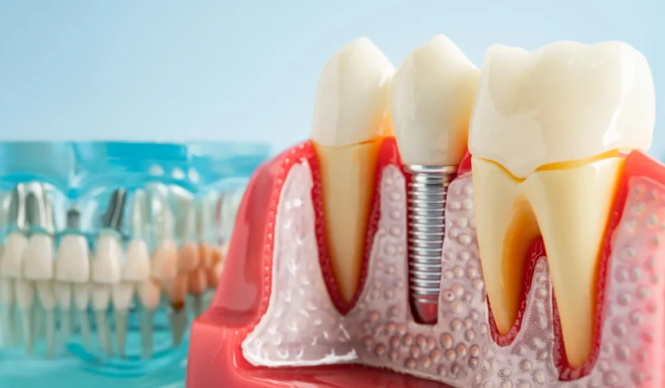 Dental Implants May Hijack Your Immune System, Scientists Find