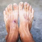 Scientists may have discovered why diabetic wounds refuse to heal