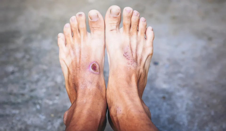 Scientists may have discovered why diabetic wounds refuse to heal