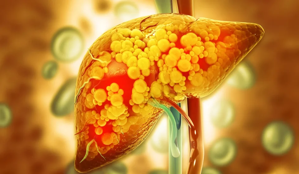 This protective enzyme may help prevent fatty liver disease from getting worse