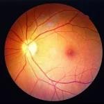 Retinal thinning observed below the A1c threshold for prediabetes