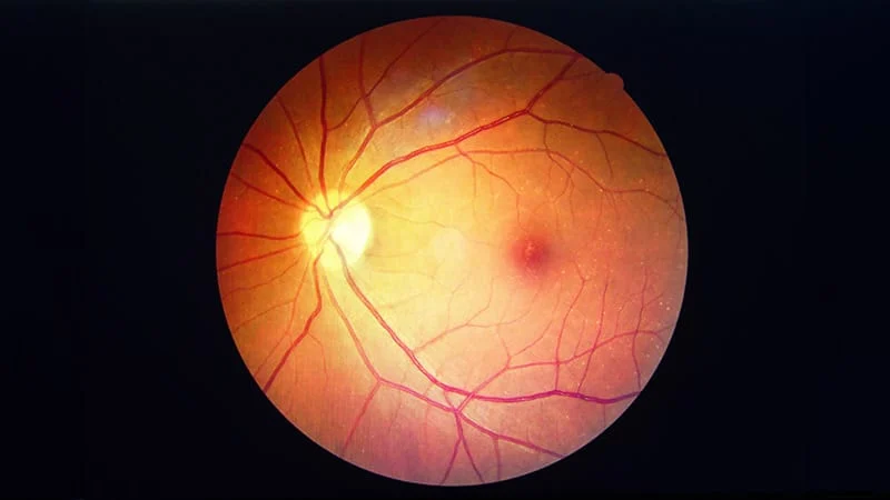 Retinal thinning observed below the A1c threshold for prediabetes Retinal thinning observed below the A1c threshold for prediabetes