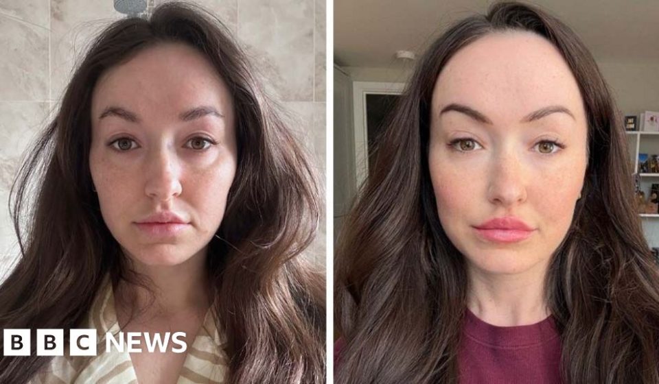 Does the “ferritin face” really exist? And can you really tell low iron from looks? -BBC