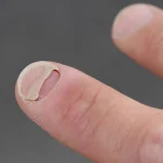 Popular Weight Loss Medications Linked to Surprising Nail Problem