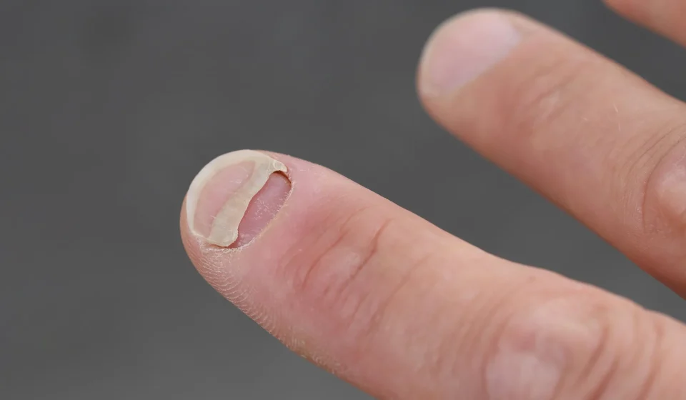 Popular Weight Loss Medications Linked to Surprising Nail Problem