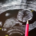 Should you undergo genetic testing before having a child?