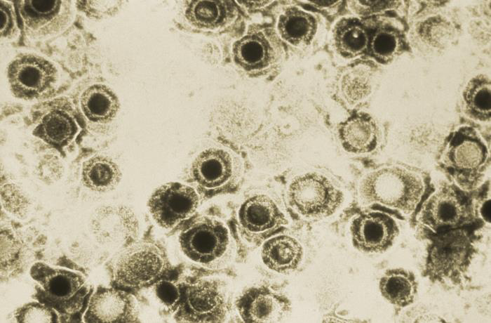 The herpes virus appears to hijack the brain's immune cells and this could have serious consequences: ScienceAlert