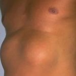 Southern California surfers diagnosed with bizarre 'tumor'