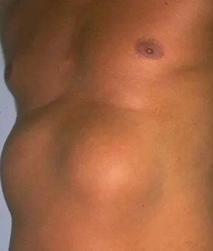 Southern California surfers diagnosed with bizarre 'tumor'