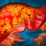 Plastic once considered harmless could fuel fatty liver disease