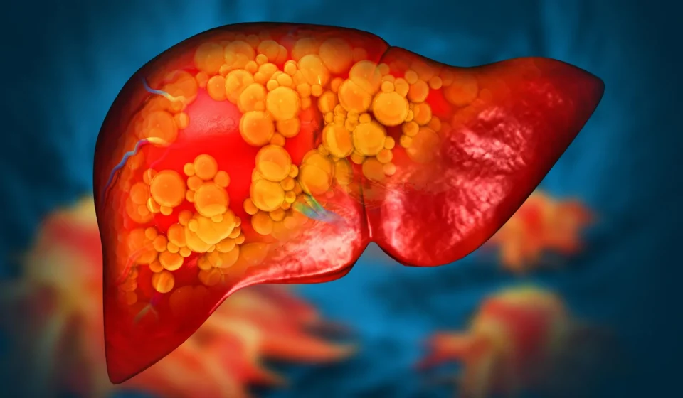 Plastic once considered harmless could fuel fatty liver disease