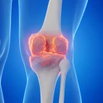 Goodbye joint replacements? Stanford scientists have found a way to regrow cartilage and stop arthritis