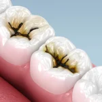 A simple liquid can seal cavities without drilling, confirms a major study
