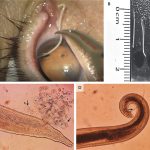 The worms mate in the human eyes and are removed just before the larvae burst