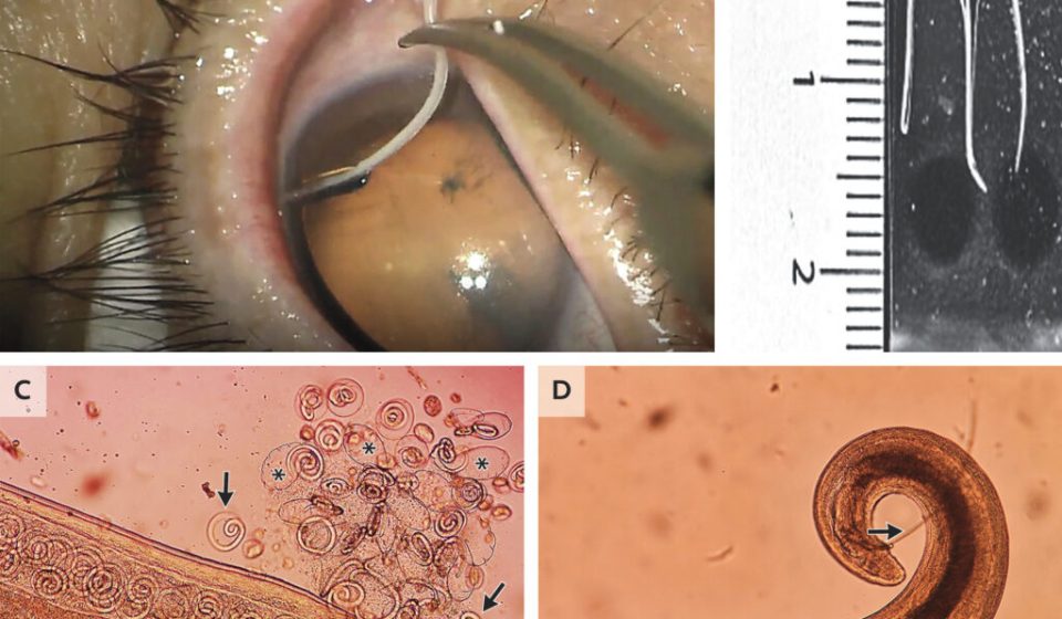 The worms mate in the human eyes and are removed just before the larvae burst