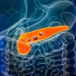 AI detects 'invisible' signs of pancreatic cancer years before diagnosis