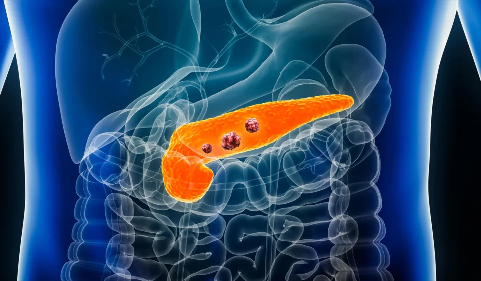 AI detects ‘invisible’ signs of pancreatic cancer years before diagnosis AI detects 'invisible' signs of pancreatic cancer years before diagnosis